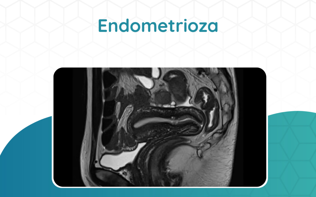 Endometrioza – diagnostyka
