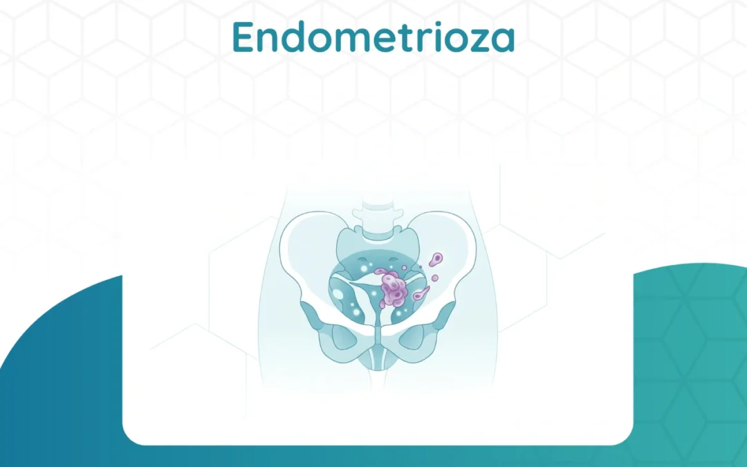 Endometrioza: Objawy, Diagnostyka
