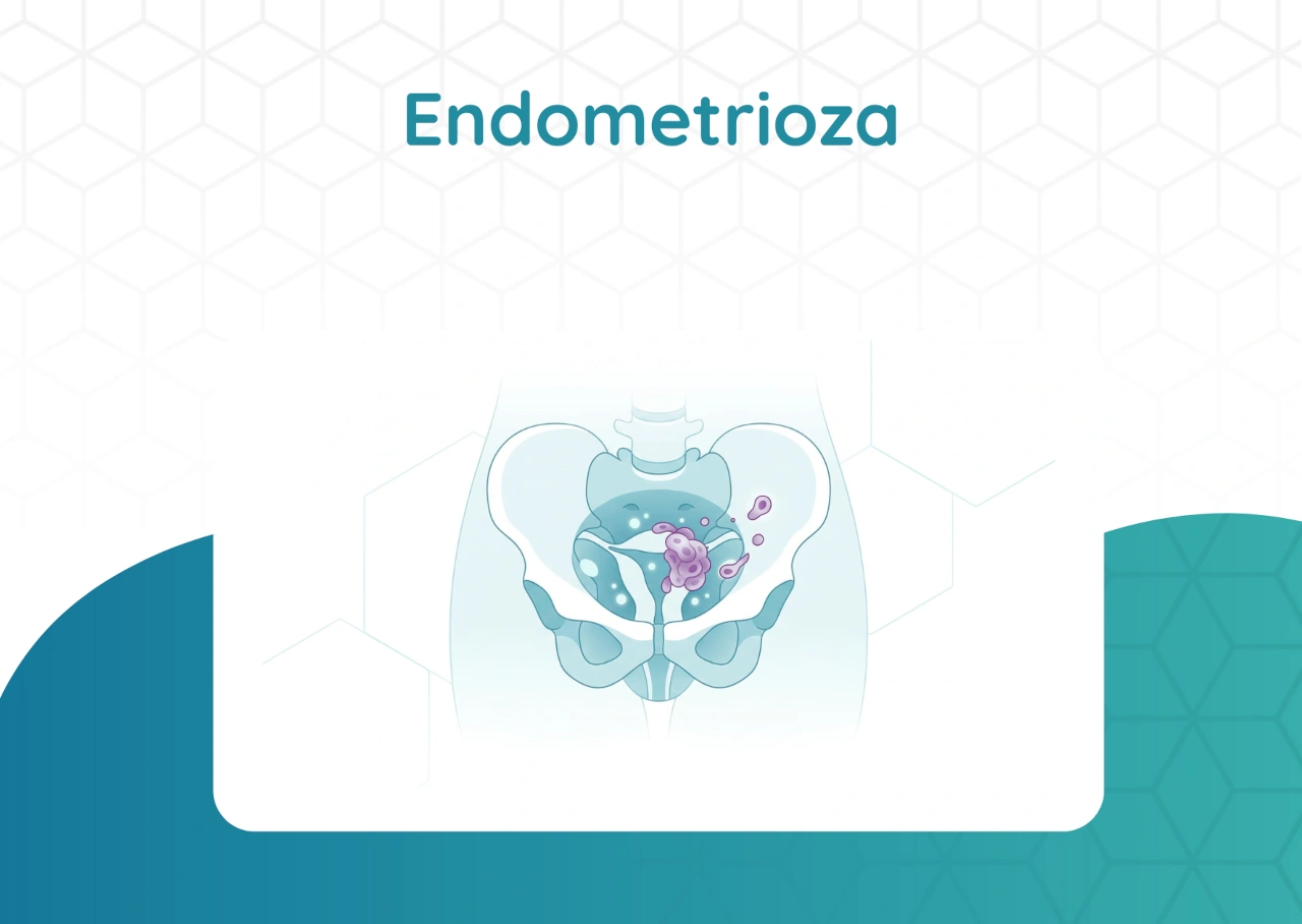 endometrioza Endometrioza